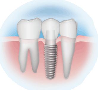 Les méthodes d’implant ont beaucoup progressé depuis quelques années, ce qui permet au patient de retrouver une dentition en bonne santé. © DR