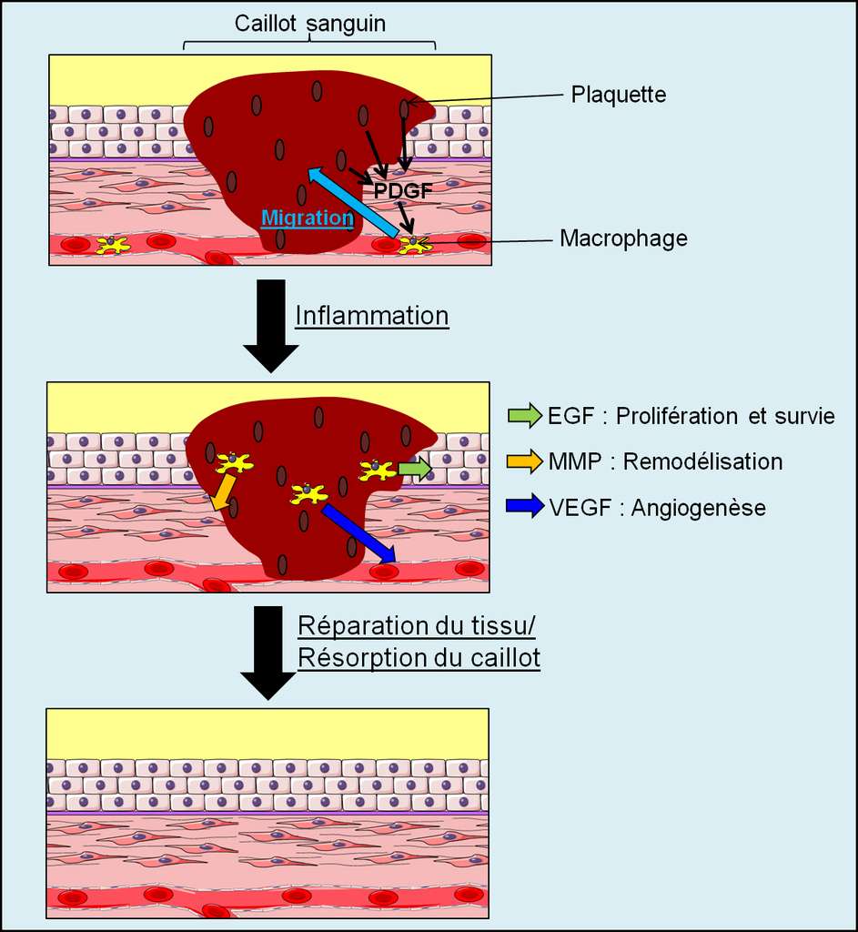 Figure 24. Inflammation causée par une blessure. Après une blessure, un caillot sanguin se forme et les plaquettes stimulent l’inflammation en recrutant des macrophages. Les macrophages sécrètent des protéines qui participent à la reconstruction du tissu sur le site de la blessure : l’EGF pour reconstruire le tissu épithélial, les MMP pour remodeler la matrice extracellulaire et le VEGF pour revasculariser la zone lésée. © Grégory Ségala