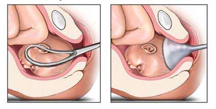 Dans certains accouchements, des forceps et une ventouse s’imposent pour faciliter l’expulsion du bébé. © DR