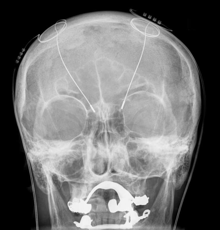 La stimulation cérébrale profonde n'est pas sans risque, car elle consiste à déposer des électrodes dans le crâne, comme on le voit sur cette radiographie. L'opération se banalise malgré tout. © Hellerhoff, Wikipédia, cc by sa 3.0