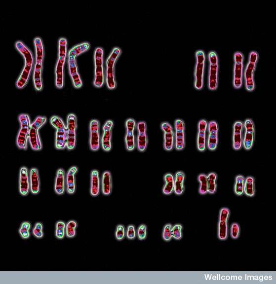 Ce caryotype montre que la trisomie 21 est une maladie génétique due à une anomalie au niveau du chromosome 21, présent en trois exemplaires au lieu de deux. © Wessex Reg, Genetics Centre, Wellcome Images, cc by nc nd 2.0