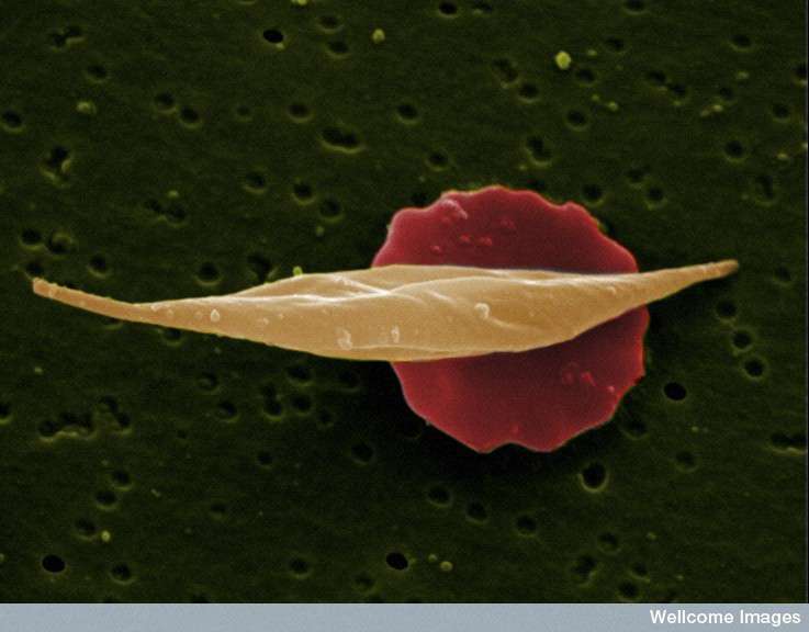 La drépanocytose, la maladie des globules rouges La drépanocytose, la maladie des globules rouges