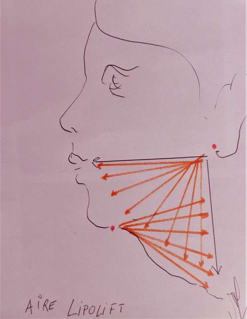 Le Lifting Du Cou Et Les Differentes Techniques Operatoires Par Le Dr Mitz