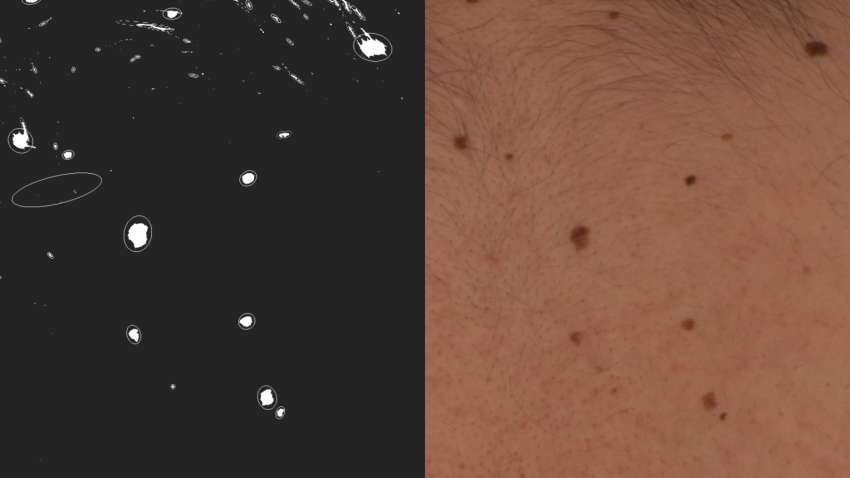 À droite, des grains de beauté sur le dos d'un patient ; à gauche, les mêmes grains de beauté en tant que cibles en forme d'étoile dans le logiciel astronomique utilisé par l'équipe de MoleGazer. © L'équipe de MoleGazer.