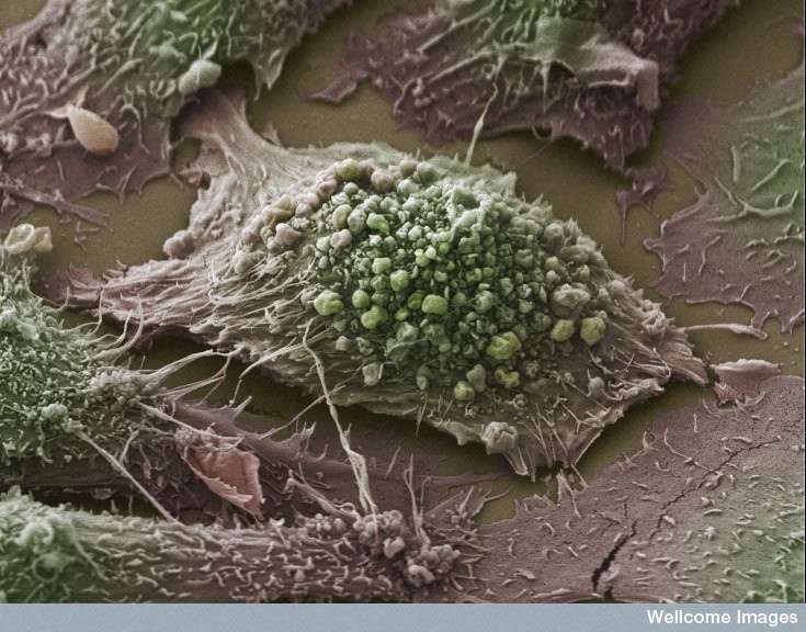 Des cellules tumorales du cancer du poumon en culture. © Anne Weston, Wellcome Images, Flickr, cc by nc nd 2.0