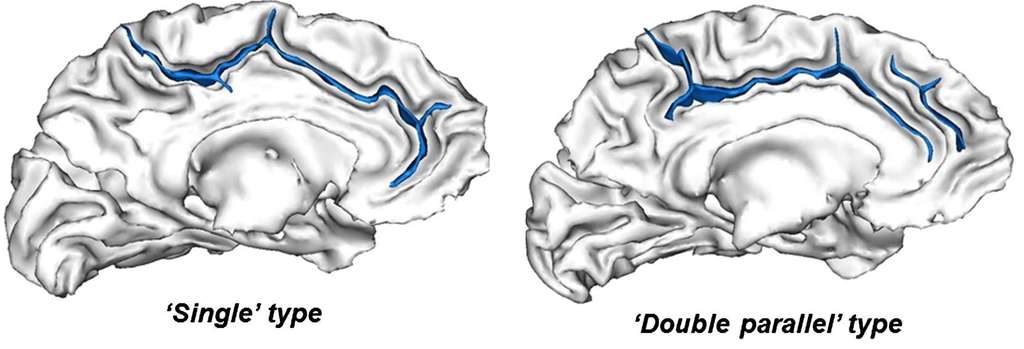 Voici les deux configurations que peuvent prendre le cortex cingulaire : un seul et unique sillon, comme à gauche, ou bien un sillon accompagné d’un deuxième, plus petit, situé en parallèle. © Arnaud Cachia et al., Journal of Cognitive Neuroscience
