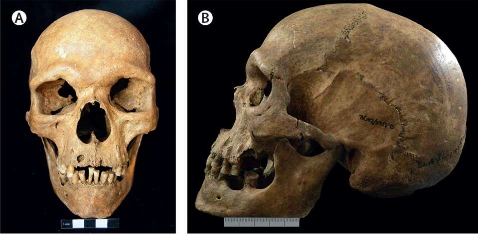Aqui está o crânio de 1.000 anos do indivíduo com doença de Klinefelter.  © Xavier Roca-Rada et al.  A Lanceta
