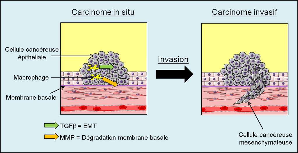 Figure 29. L’invasion tumorale. Des cellules associées à la tumeur, comme les fibroblastes ou les macrophages, sécrètent le facteur transformant TGFβ qui induit l’EMT chez les cellules cancéreuses épithéliales. En parallèle, la sécrétion de MMP par les macrophages et les cellules cancéreuses provoque la rupture de la membrane basale et l’invasion du mésenchyme par les cellules cancéreuses ayant effectué l’EMT (cellules cancéreuses mésenchymateuses). © Grégory Ségala