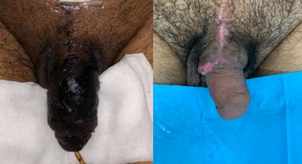 À gauche, le pénis sept jours après sa réimplantation, montre des tissus nécrosés. À droite, le pénis trois mois après la réimplantation et la greffe de peau. © Nader Henry et al, BMJ Case Reports, 2020