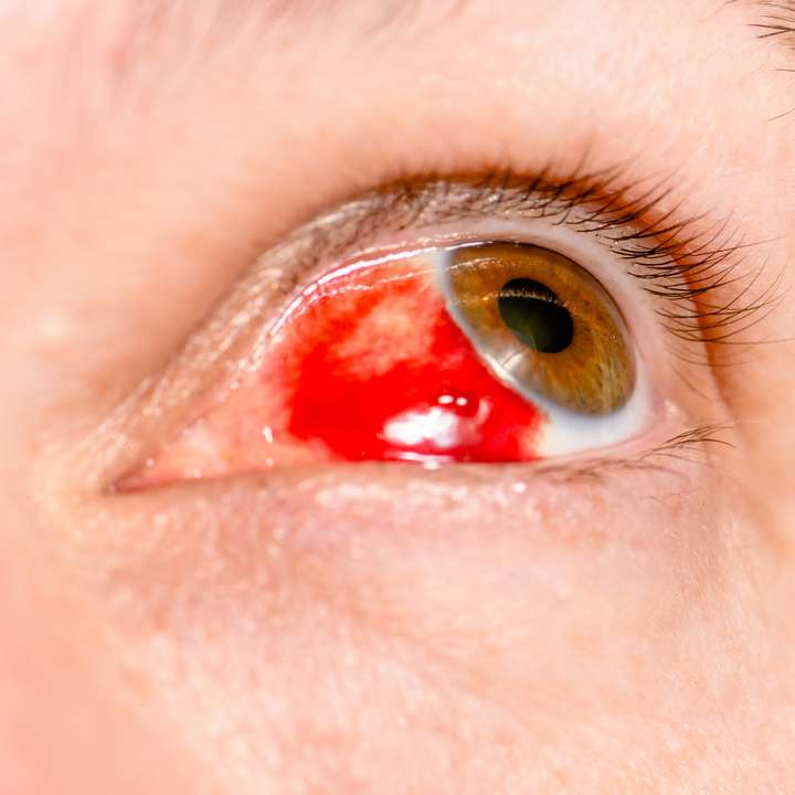 Tache rouge dans l'œil : causes et traitement