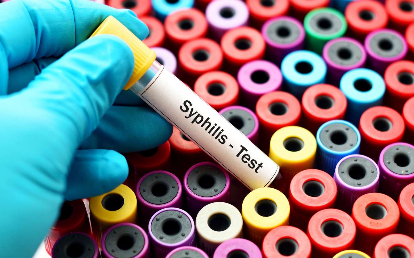 Forte progression de la syphilis en Europe : 70 % de cas en plus ...