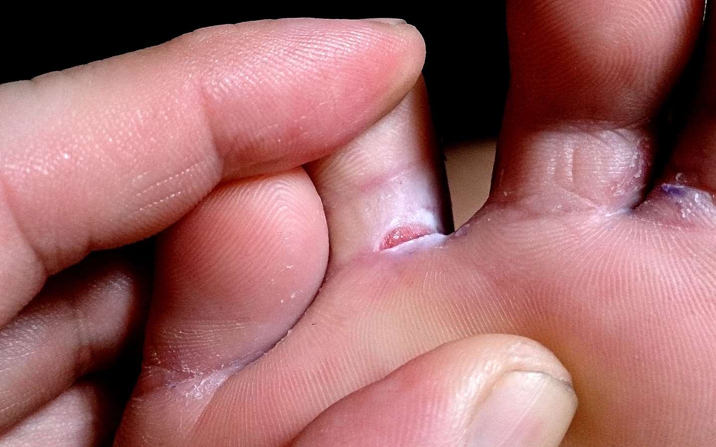 Mycose des pieds : symptômes et traitements