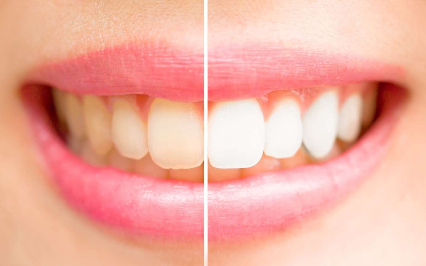 Dents blanches : cinq conseils faciles