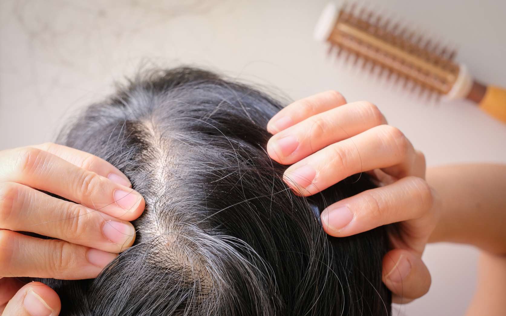 La chute de cheveux est largement liée à des facteurs génétiques mais il ne faut pas l’aggraver avec des mauvaises habitudes. © paulynn, Fotolia