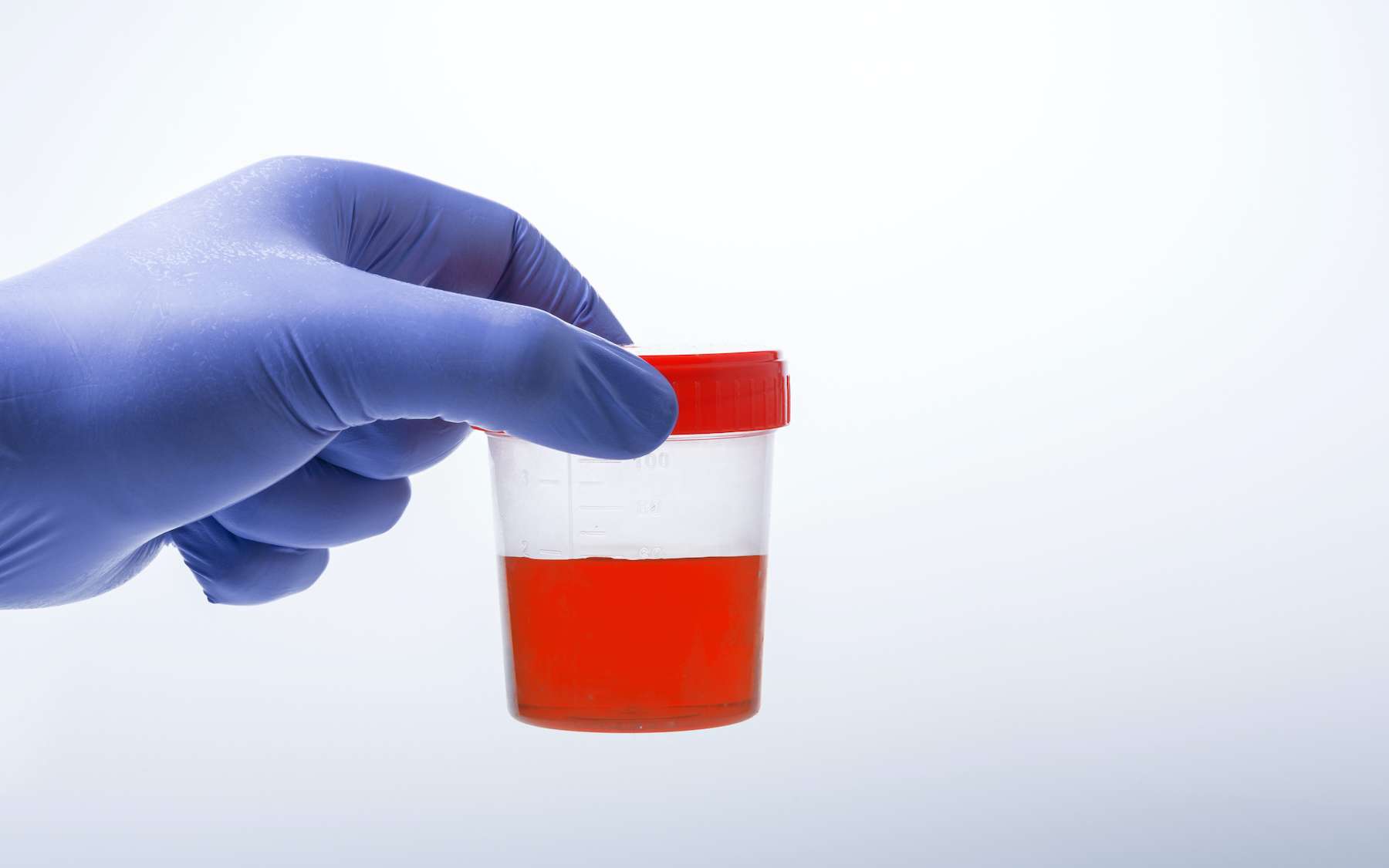 L’hématurie se traduit par la présence de sang dans les urines. © sercansamanci, Adobe Stock