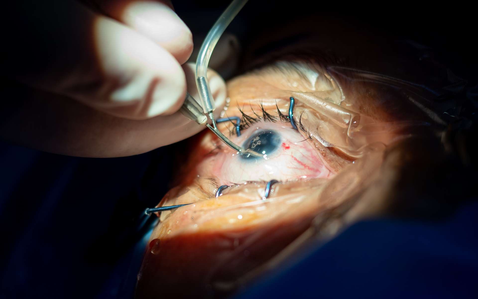 Patient bizarre : les conséquences spectaculaires des tatouages des yeux