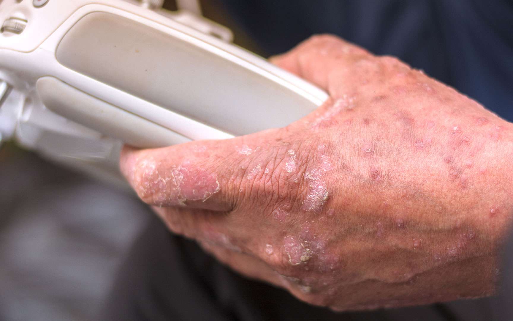 Eczema Quels Traitements Naturels