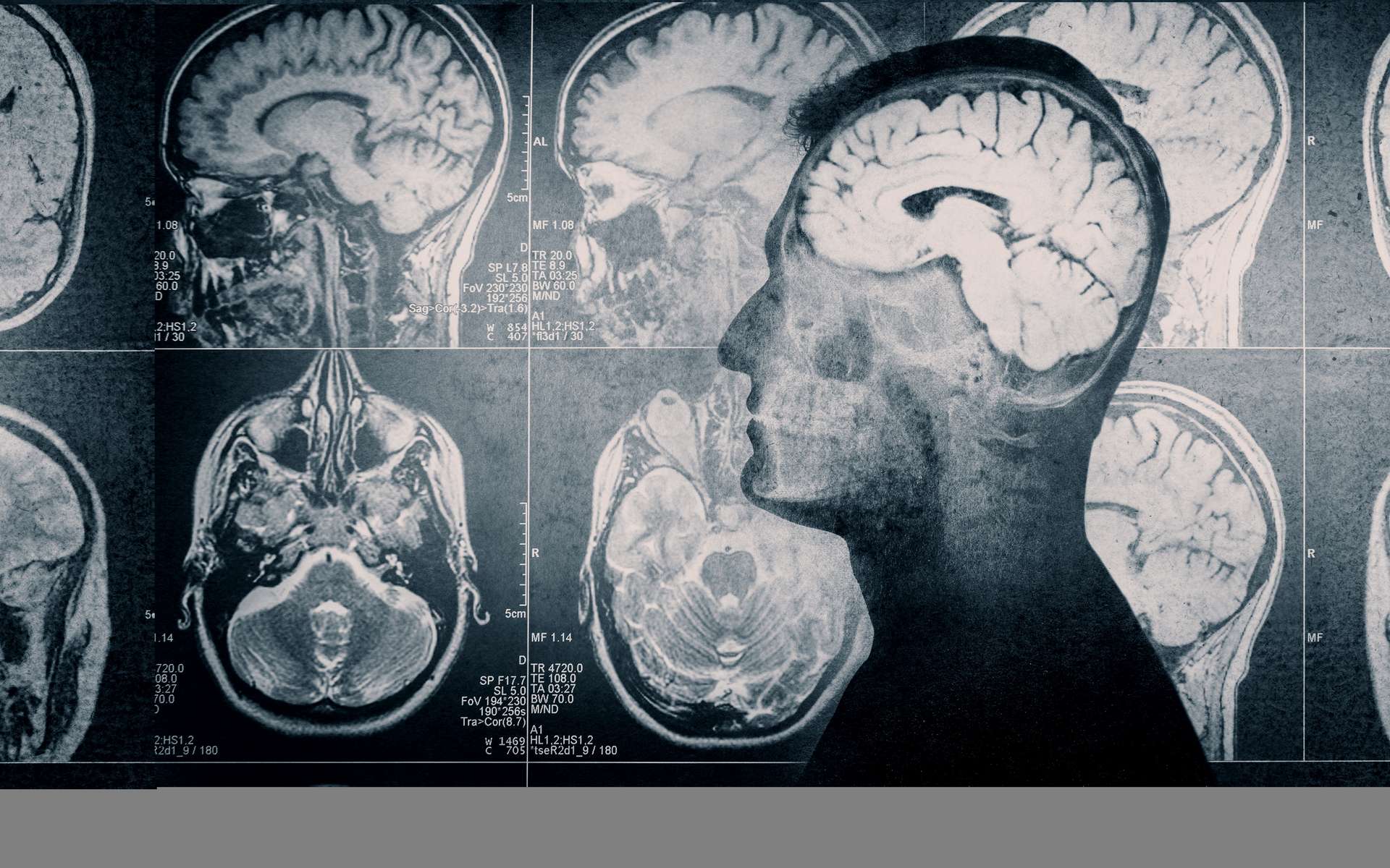 Un marqueur dans le cerveau pourrait prédire la démence avec 5 à 10 ans d'avance !