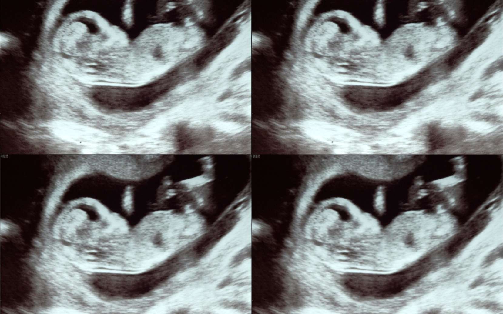 Patient bizarre : enceinte de quadruplés dans deux utérus différents