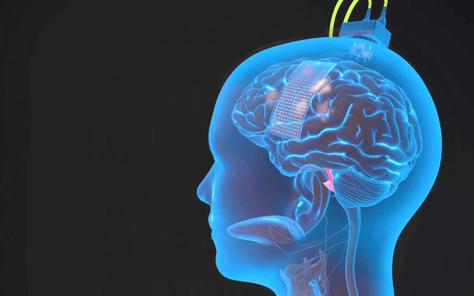 Ces interfaces cerveau-machine bootées à l'IA redonnent la voix à deux femmes