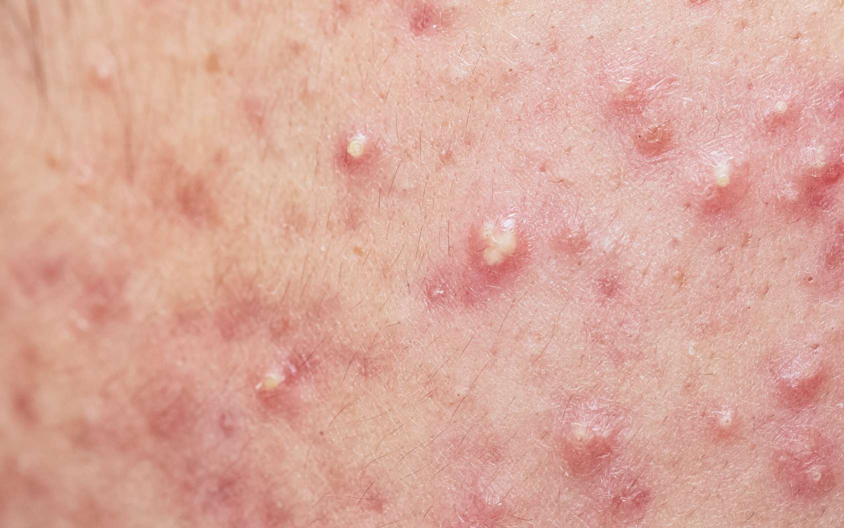 L’acné conduit à la formation de boutons, comme des points blancs. © praisaeng, Fotolia