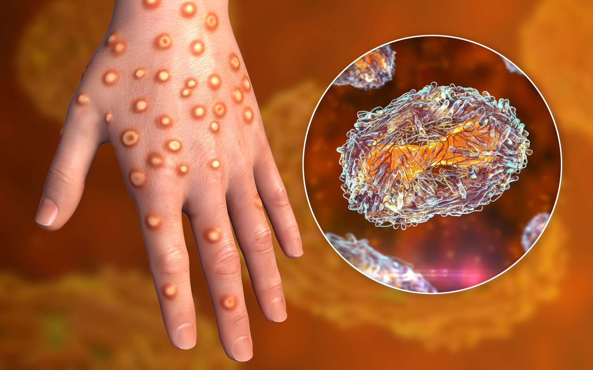 Nouvelle souche du virus Mpox : ce qui inquiète le plus l'OMS qui a déclaré l'état d'urgence mondiale