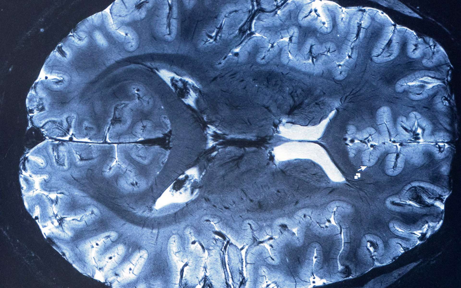 Le CEA obtient les images par IRM du cerveau les plus précises au monde pour mieux comprendre Alzheimer