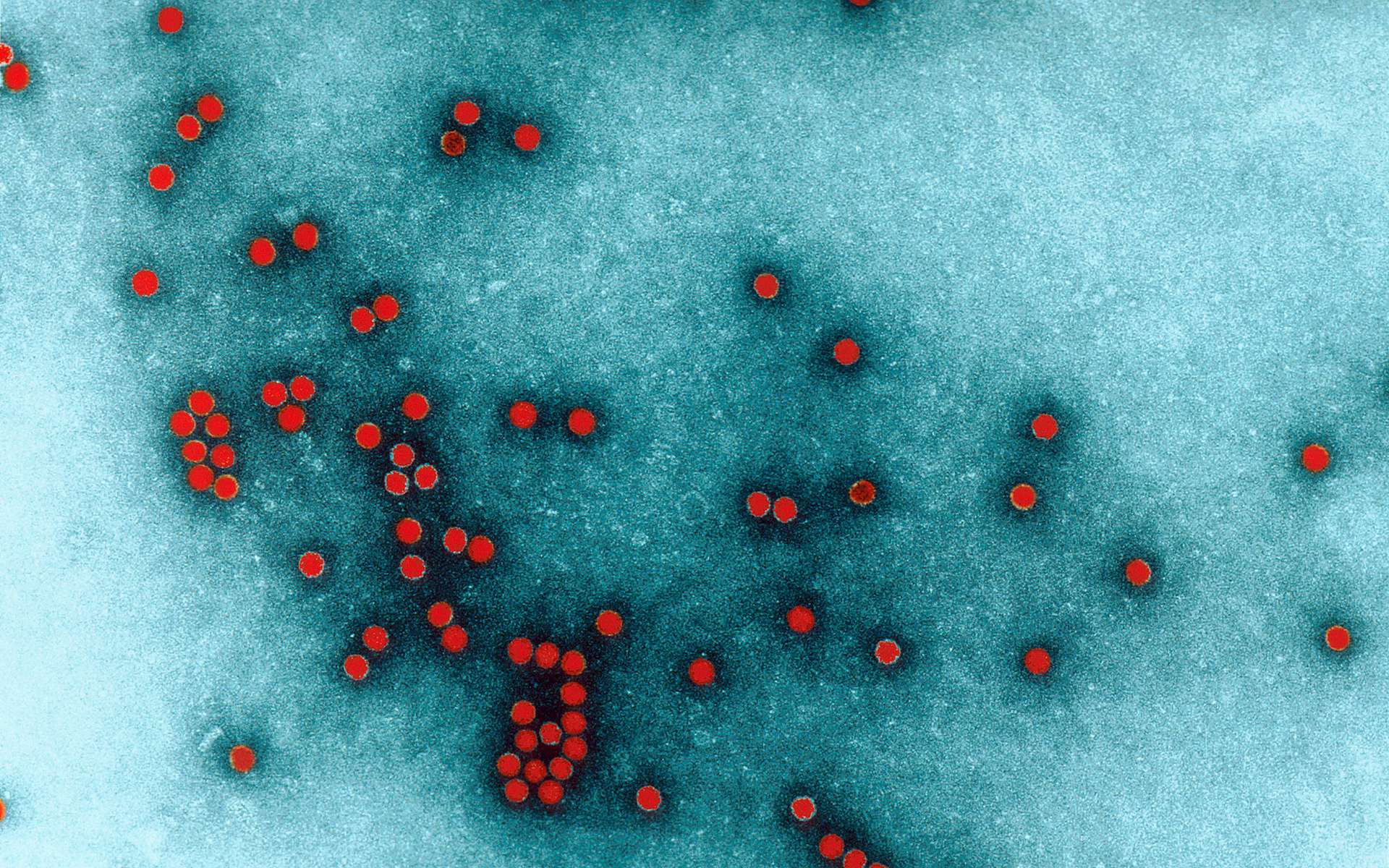 Un cas confirmé de poliomyélite aux États-Unis, des centaines d'autres personnes peut-être infectées
