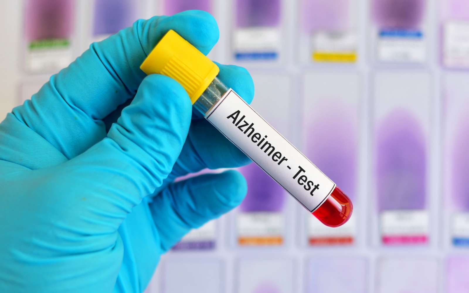 Un nouveau test sanguin révolutionnaire pour détecter la maladie d'Alzheimer