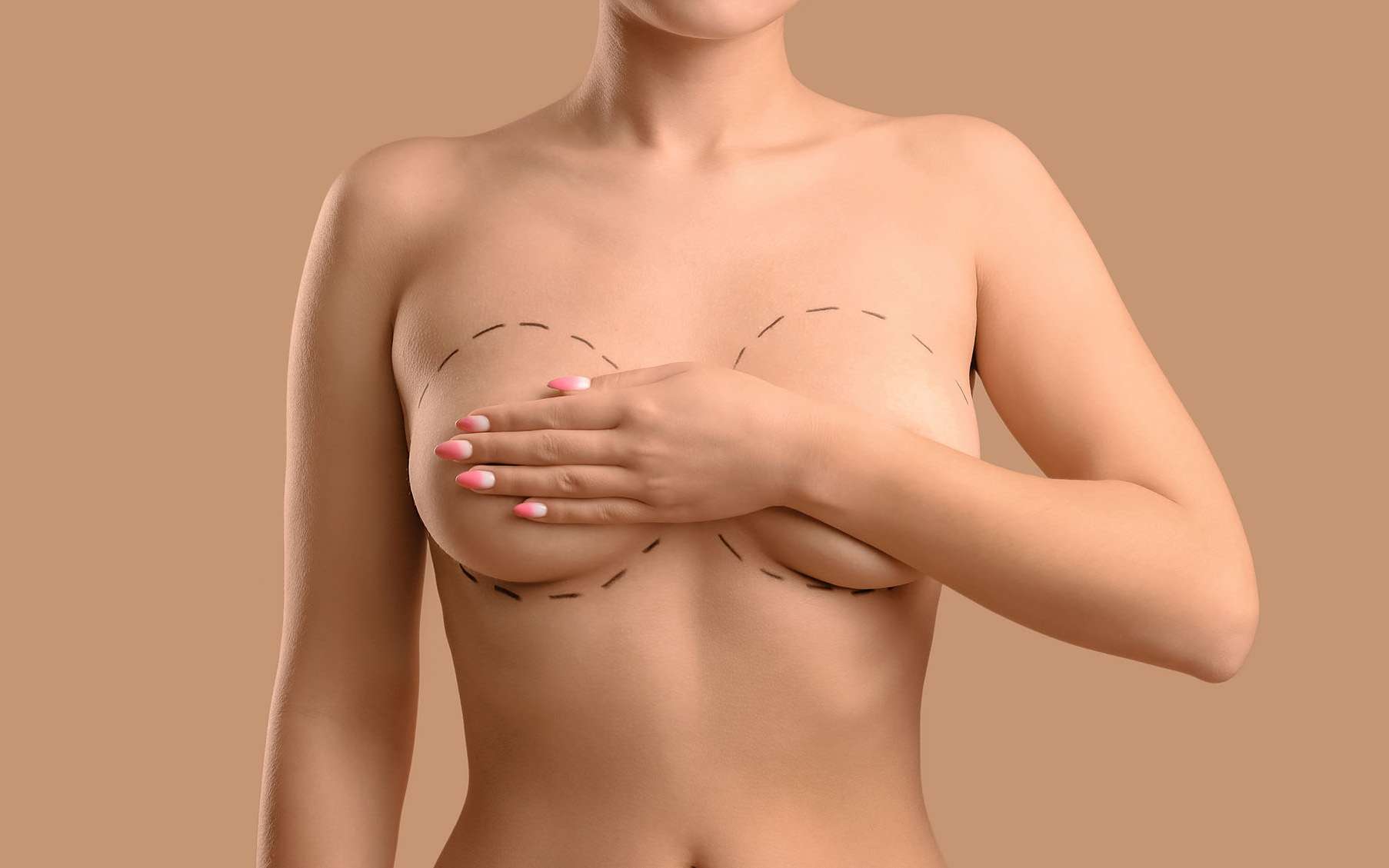 Implants mammaires en silicone : y a-t-il du nouveau en 2025 ?