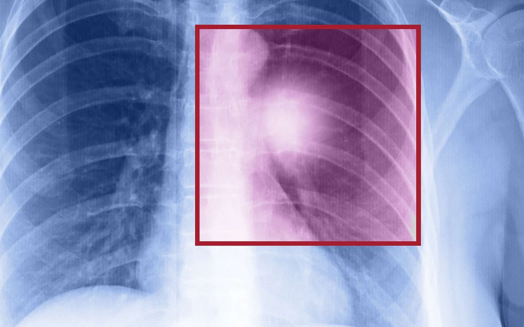 Le cancer du poumon peut être détecté par une radiographie, un scanner thoracique et une biopsie. © muratart, Shutterstock