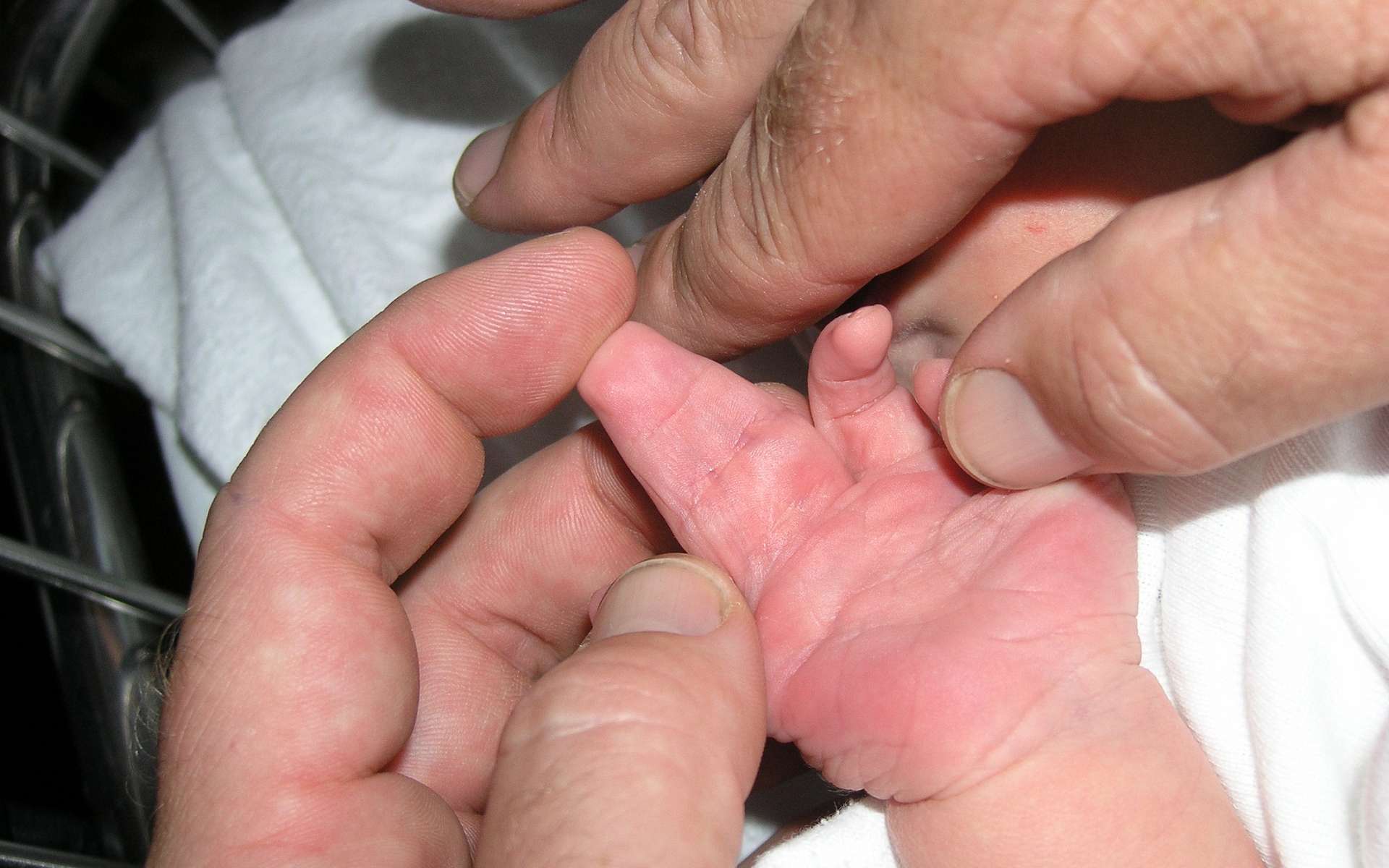 Ce bébé a deux doigts qui ne sont pas correctement séparés : c'est une syndactylie. © Wikipedia, domaine public