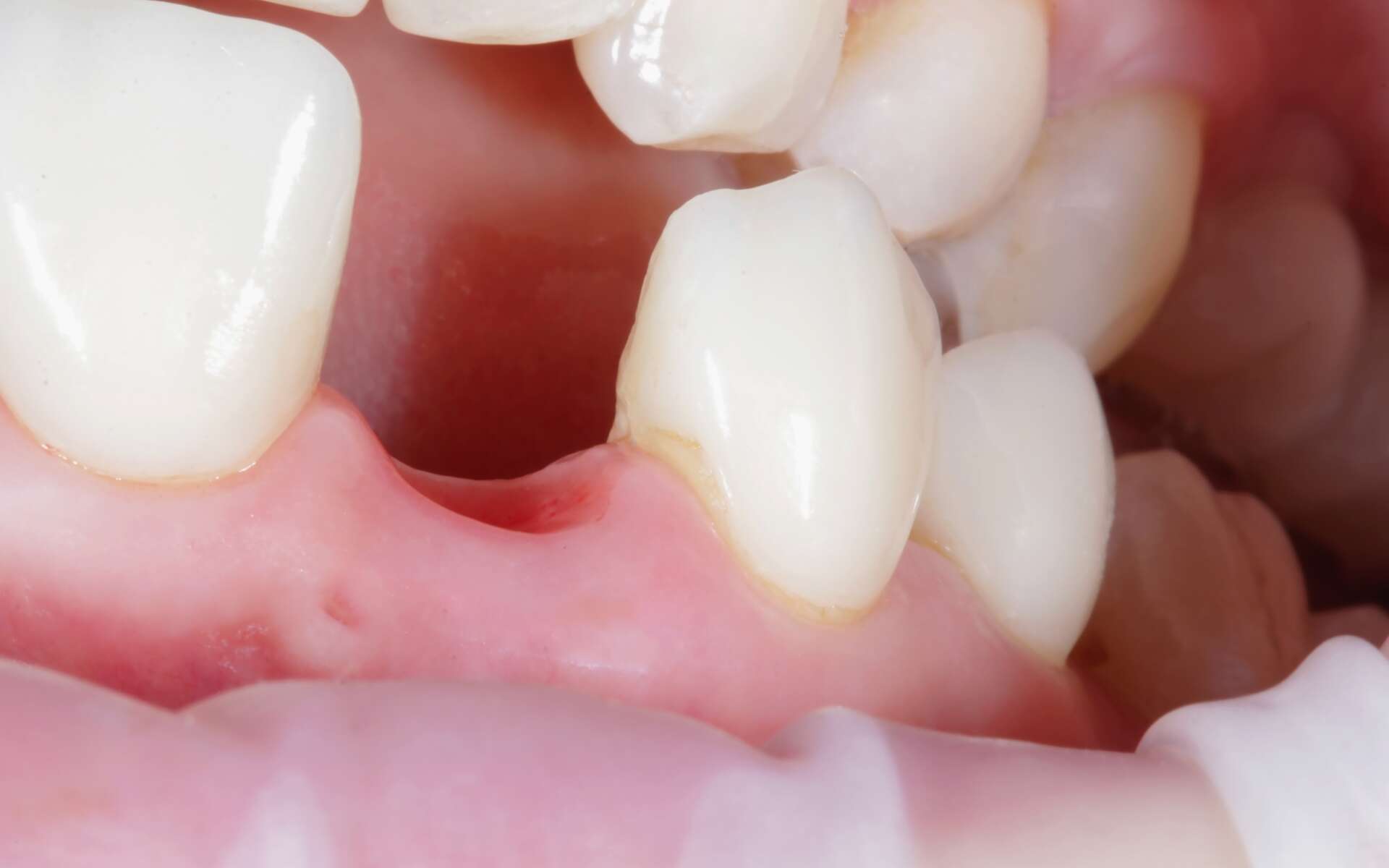 Un médicament qui fait repousser les dents bientôt en essai clinique