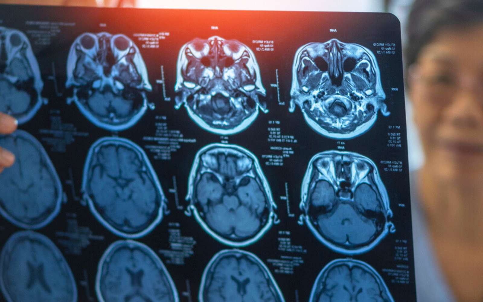 Alzheimer : ce nouveau coupable qui bouleverse nos certitudes sur la maladie