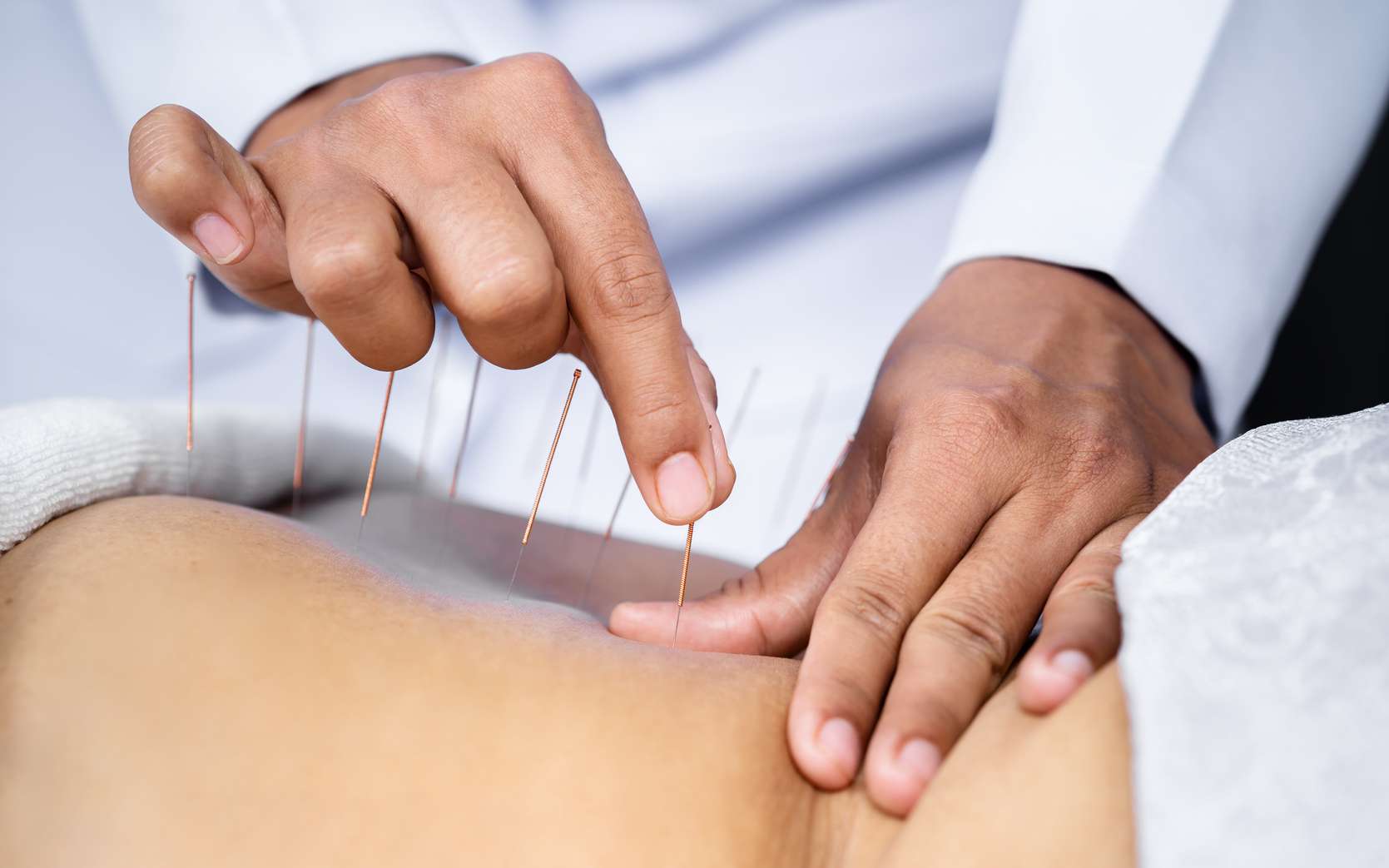 L'acupuncture en plus des traitements : effets réels ou contextuels ?