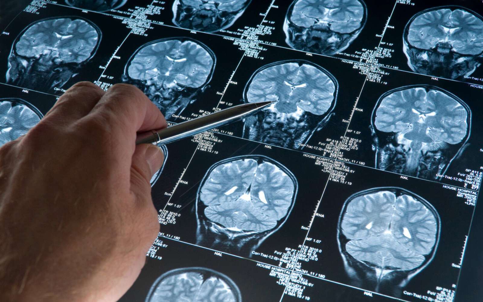 Une expérience choc : le transfert d'Alzheimer sur des sujets jeunes réussi