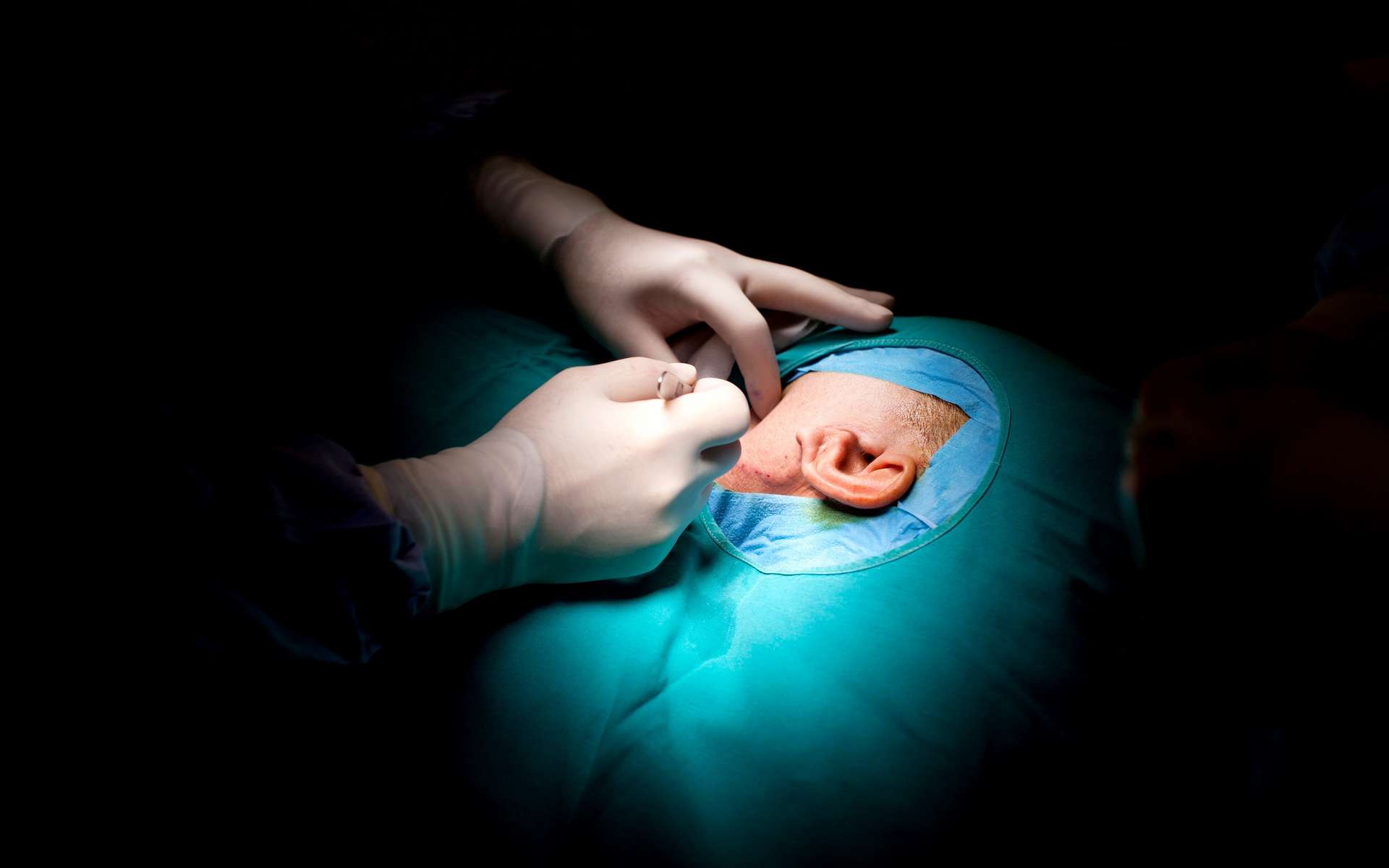 Un implant expérimental de tissu vivant bio-imprimé en 3D a été greffé sur une patiente atteinte de microtie, une maladie congénitale qui se caractérise par une oreille externe incomplète. © Ciseren, Getty Images