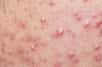 L'acné provoque&nbsp;des boutons sur le visage, le thorax ou le dos. © Praisaeng, Fotolia