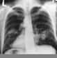 Le cancer du poumon reste de loin le plus mortel. Il est donc indispensable d'améliorer le diagnostic et les traitements afin de changer le pronostic. Quid des dix prochaines années en la matière ? Petit tour d'horizon...
