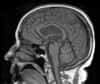 Le cerveau nous révèle peu à peu son architecture. Ainsi, la cartographie des régions du lobe frontal impliquées dans la prise de décision et le contrôle du comportement vient d’être réalisée avec un niveau de détail encore jamais égalé, grâce aux données recueillies auprès d’environ 350 patients atteints de lésions cérébrales.
