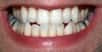 Le fluor est bon pour les dents, peut-être, mais la couche fluorée recouvrant l’émail serait bien plus fine que ce que les scientifiques pensaient. Tellement fine que l’on peut se demander si elle est vraiment protectrice…
