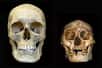 Les petits hommes de Florès (Homo floresiensis) n’étaient peut-être que des êtres humains ordinaires, mais atteints d’une forme endémique de crétinisme provoquée notamment par une grave carence en iode. C'est la curieuse thèse de deux chercheurs australiens, qui relancent une controverse déjà vive.