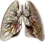 Les enfants qui vivent dans des endroits où l'air est pollué, encourraient un risque cinq fois supérieur de fonction pulmonaire cliniquement basse, correspondant à moins de 80 % de la fonction pulmonaire attendue pour leur âge.