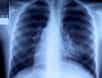 Une étude américaine a suivi plus de 150.000 personnes sur treize ans afin d'évaluer l'efficacité des radios du thorax dans le dépistage précoce du cancer du poumon et l'amélioration de son taux de survie. Il en ressort que ces radiographies annuelles ne permettent pas de réduire la mortalité de ce cancer. Le dépistage par tomodensitométrie serait bien plus avantageux.