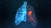 Des résultats présentés lors d'un congrès de pneumologie indiquent que les non-fumeurs et les femmes sont de plus en plus concernés par les cancers du poumon.