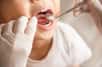 La carie dentaire est la dégradation, ou la destruction, de l'émail des dents. L'émail est la surface extérieure dure d'une dent. La carie dentaire peut entraîner des trous dans les dents.