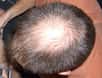 L'alopécie désigne toutes les formes de pertes de cheveux et peut toucher les deux sexes. © Mike Burn, Flickr, CC by-sa 2.0