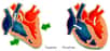 La diastole correspond à la phase de relâchement du coeur. Crédits DR