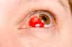 Une tache de sang dans le blanc de l’œil est souvent impressionnante, mais c’est rarement une urgence médicale. Quelles sont ses causes et comment la soigner ?