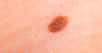 Le grain de beauté ou naevus est un amas de cellules mélanocytaires (les cellules pigmentaires) dans la peau, formant le plus souvent une petite tache marron ou une petite grosseur cutanée rosée ou brune. On le retrouve principalement sur les zones exposées au soleil (dos chez l'homme, jambes chez la femme...).